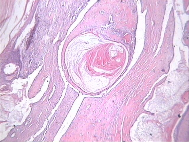 Fig. 5    Pequeo quiste crneo en un phyllodes - <div style=